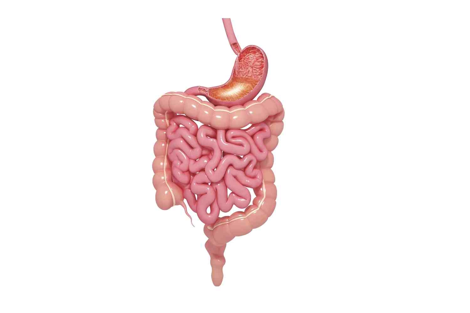 Colectomia total