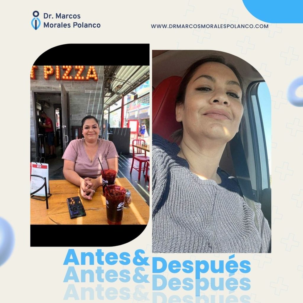 Antes y después 1