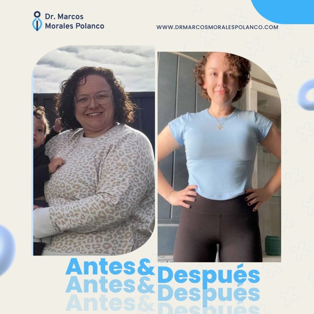 Antes y después 15