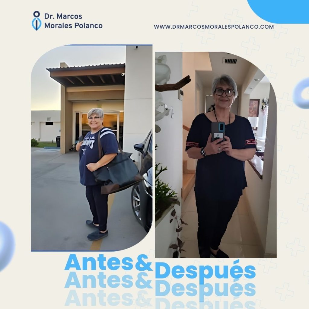 Antes y después 17